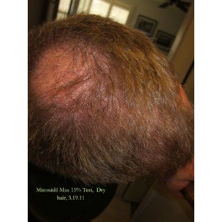 Dualgen 5 NO PG: Topical Hair Loss Treatment, For Sensitive Scalp : Hair Regrowth Treatments : Beauty
