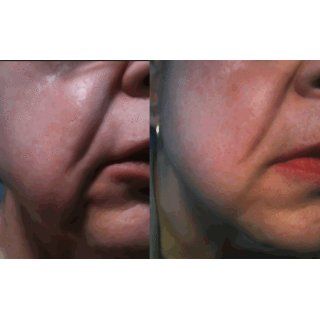 Tripollar Stop   Anti Aging Facial Skin Treatment Health & Personal Care